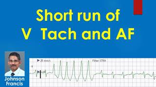 Short run of Ventricular Tachycardia and Atrial Fibrillation [upl. by Tiphani]