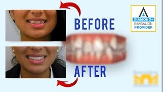 Invisalign Before and After Crowded Teeth [upl. by Meehyrb634]