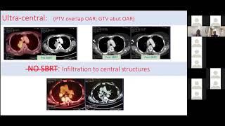 Session6 “overview of SBRT in lung cancer” by Dr Shyam Part A [upl. by Pinzler]