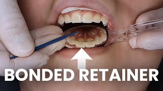 Getting a Bonded Retainer put on AFTER Getting Braces Off [upl. by Blank]