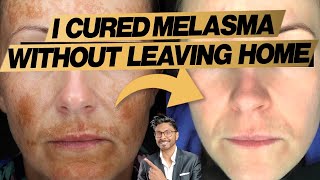 Melasma Treatment At Home Expert Doctors 3 Easy Steps  before and after [upl. by Anidene620]