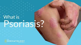 What Is Psoriasis [upl. by Idhem969]