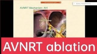 AVNRT ablation  AV nodal reentry tachycardia EPStudy Electrophysiology by DrNarendraKumar [upl. by Eatton]