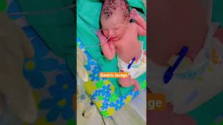 Gastric lavage  newborn gastric lavage baby GL crybaby baby ytshorts cute youtubeshort [upl. by Trotter]