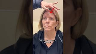 Facial reanimation surgery preop facialparalysis plasticsurgery smilereanimation [upl. by Aneela]