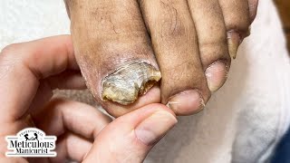 Tips to Treat Nail Fungus at Home [upl. by Fusuy]