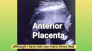 Anterior placenta baby gender  12 weeks Twin pregnancy  3 vessel cord or turtle sign  ultrasound [upl. by Aivital]