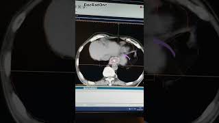 Intraluminal Brachytherapy ILBT [upl. by Shult190]