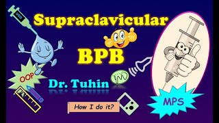 Modified Parasagittal Approach  Supraclavicular Brachial Plexus Block  OutofPlane  Ultrasound [upl. by Niawat915]