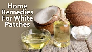 Home Remedies For White PatchesLeucoderma [upl. by Sesylu]