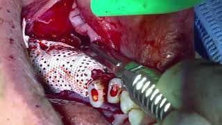 posterior mandible GBR Ti reinforced ptfe adaptationscrewingtackinggraft buccal flap release [upl. by Ehtylb257]