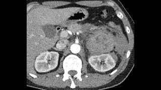 Pheochromocytoma bleeding  Life Threatening condition  Beware [upl. by Pinebrook]