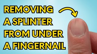 My Simple Trick to Instantly Remove a Splinter From Under Your Fingernail watch until the end [upl. by Wier73]