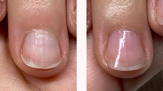 OVERGROWN CUTICLE or STRETCHED PROXIMAL NAIL FOLD 2 WEEK PROGRESS WATCH ME WORK [upl. by Gurias]