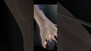 Carpal Tunnel Surgery Step by step [upl. by Cadal]