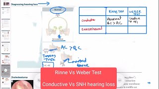 Conductive vs sensorineural hearing loss neurology 159 First Aid USMLE Step 1 in UrduHindi [upl. by Kano239]