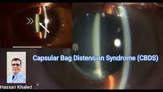 Capsular Bag Distension Syndrome CBDS [upl. by Sueddaht80]