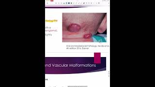 Hemangioma  Vascular malformations and Lymphangioma [upl. by Dwaine]