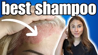 BEST Shampoo For Psoriasis  Dermatologist Recommended [upl. by Eyak]