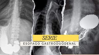 SERIE ESÓFAGO GASTRODUODENAL ESTUDIO RADIOLÓGICO radiologia radiology [upl. by Mendez]