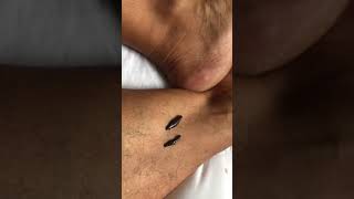 Leg amp Ankle Leech Therapy procedure Medical leeches 4 diabetes varicose veins leg thigh pressure [upl. by Aenehs]