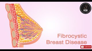 Fibrocystic Breast Disease Symptoms Causes amp Treatment Options  KnowHow Hub [upl. by Snapp393]