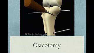 Dome osteotomy for knee osteoarthrosis [upl. by Ahsaekal]