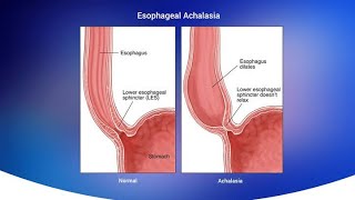 Achalasia Cardia Failure of Abdominal esophagus Sphincter to open for food passage [upl. by Melquist]