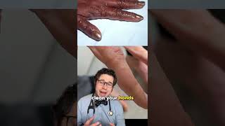 What is dyshidrotic eczema eczema rash doctor [upl. by Aynnek]