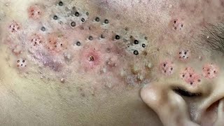 Big Cystic Acne Blackheads Extraction Blackheads amp Milia Whiteheads Removal Pimple Popping  3283 [upl. by Leunammi182]