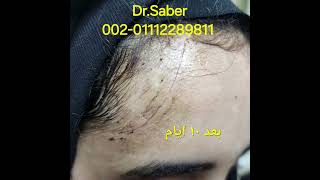 تجميل اثار الجروح و الندبات بوتوكسscar revision قبل و بعد أفضل طبيب تجميل مصر  دصابر عبد المقصود [upl. by Aliuqaj]