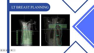 Breast planning 3DIMRT and VMAT MONACO and Raystation [upl. by Catarina]