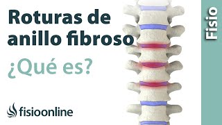 Roturas anulares o del anillo fibroso discal  ¿Qué es [upl. by Jonette]