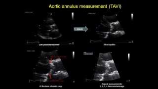 AORTIC ANNULUS MEASUREMENT  TAVI  transcatheter aortic valve implantation [upl. by Friedly860]