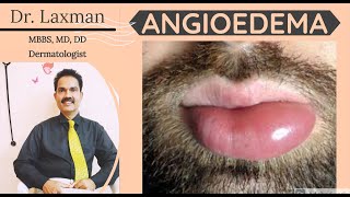 What Is Angioedema  Angioedema  Causes N Treatment  Allergy  Dermatology [upl. by Nnanaej]