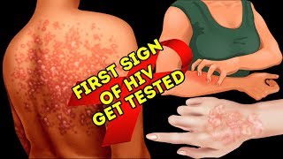 What Is Usually The First Sign Of HIV [upl. by Ostler353]