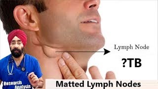 Matted Lymph Nodes क्या होता है  Lymphadenopathy  TB  DrEducation Hindi [upl. by Leonor]