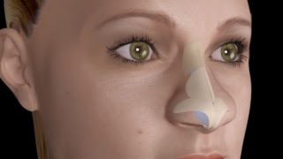 Bulbous Large Nasal Tip Nose Job Rhinoplasty [upl. by Cori216]