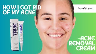 Triac Anti acne cream Review  Went from Acne Prone skin to Clear Skin  Honest Review [upl. by Anastase]