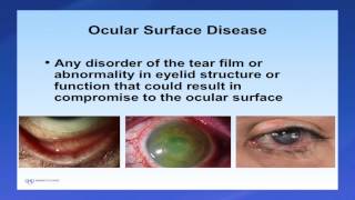 Introduction to Scleral Lenses [upl. by Notxam]