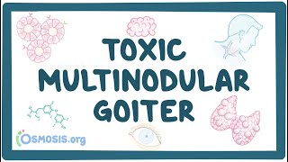 Toxic multinodular goiter  causes symptoms diagnosis treatment pathology [upl. by Rehpitsirhc]