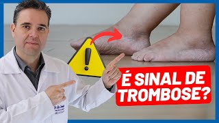 INCHAÇO NA PERNA É UMA TROMBOSE  Dr Alex Vascular [upl. by Amata]