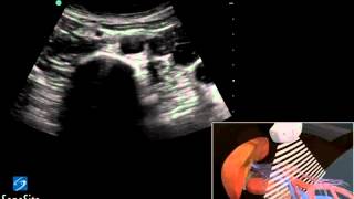 Guide 3D Ecografia Aorta Addominale  Ecografia SonoSite [upl. by Chen]