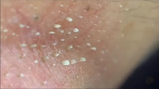 Satisfying and Relaxing ASMR Plucking Massive WhiteheadsBlackheads sebum removal 피지제거 大量角栓 去除皮脂 [upl. by Feenah]