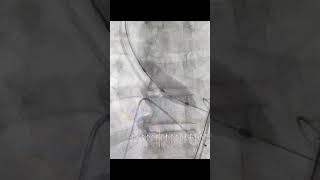 Balloon Aortic Valvuloplasty BAV procedure and details [upl. by Temhem949]