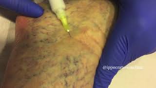 Sclerotherapy highlights [upl. by Gallard]