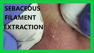 Sebaceous FILAMENT Extraction [upl. by Brien]