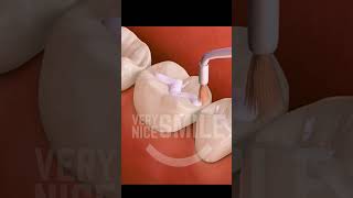 What is a Dental Sealant sealant sealants cavities nocavities dentist dentistry [upl. by Spracklen86]