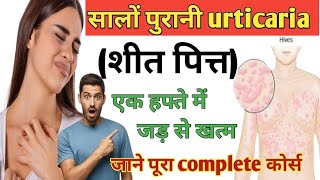 सालों पुरानी urticaria 30 दिन में जड़ से खत्म urticaria livcon capsule and assicon syrup urticaria [upl. by Bevin]