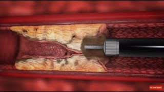 TurboElite laser atherectomy animation [upl. by Alage]